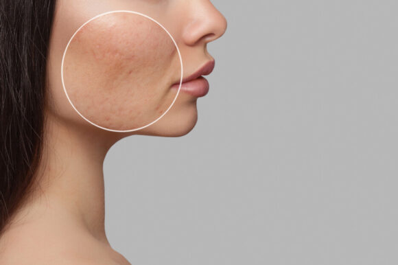 Microneedling for Acne Scars: A Fresh Start for Your Skin